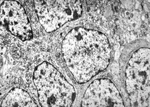 M,1y. | neuroblastoma - retroperitoneum